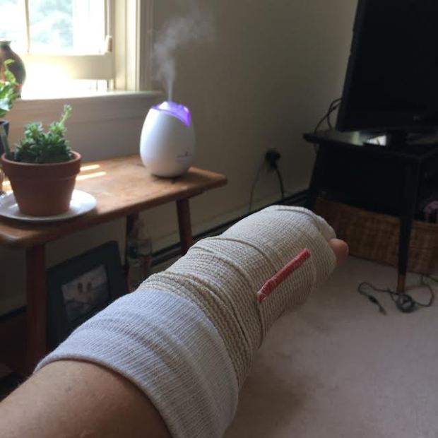 arm cast 2015
